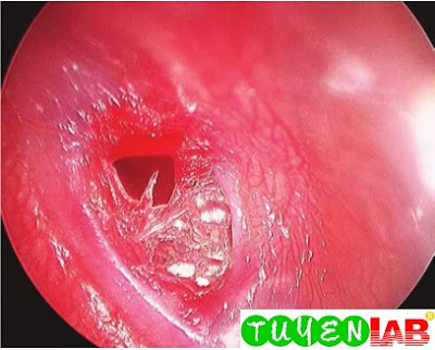 Traumatic perforation of the left tympanic membrane
