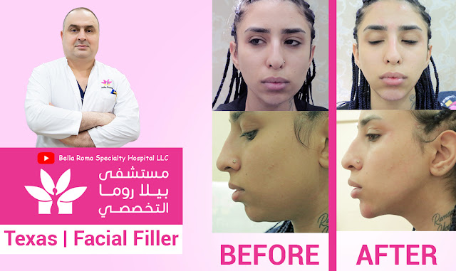 Improve you face by Texas face contouring in Bella Roma Hospital