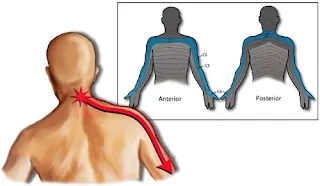 Cervical Radiculopathy