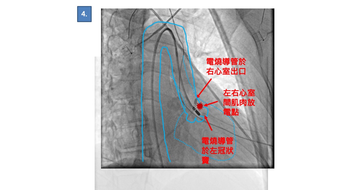 虛線是右心室投影位置，實線是主動脈和左心室出口冠狀竇的投影位置