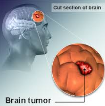 http://obatpenyakittumor.com/obat-tumor-otak/