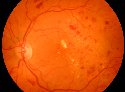 diabetic retinopathy risk factors and it's stages