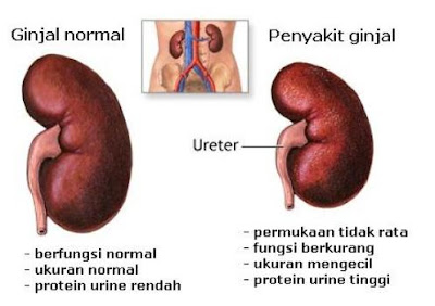 Terungkap! Inilah Akibat Asam Urat Tinggi yg Wajib Diwaspadai