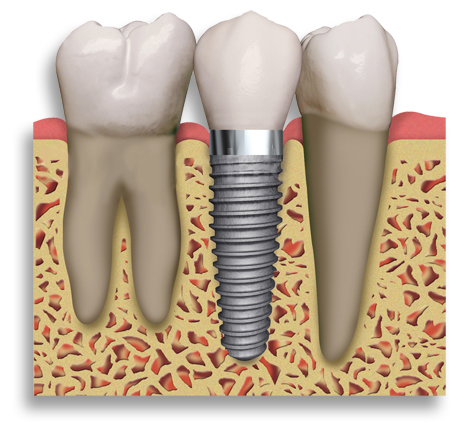 cay-ghep-rang-implant-cay-ghep-implant-nha-khoa-thuan-kieu-2015