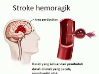 MINYAK KUTUS KUTUS, BISA MEMBANTU PERCEPATAN PENYEMBUHAN STROKE