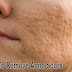 How to Remove Acne Scars Fast At Home