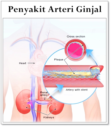 Pengobatan Herbal Penyakit Arteri Ginjal