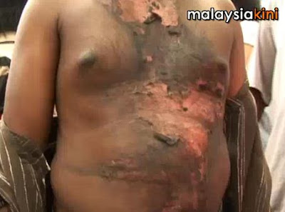 B Prabakar boiling water victim