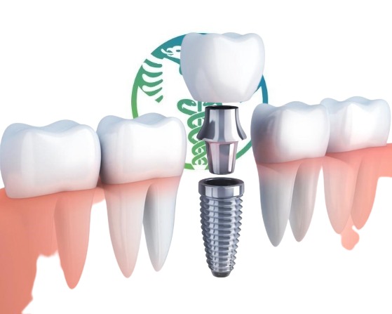 For only 2990 € 'All on 4', full arch, 12 crowns in zirconia on 4 dental Implants in Albania,