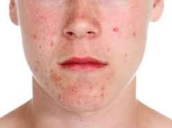 Mandíbula causa acne em adultos e, especialmente, nas mulheres é por causa de problemas hormonais ea inatividade hormonal.