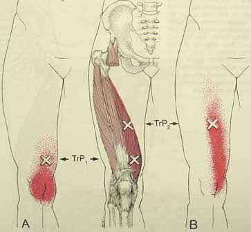 MIOTERAPIA