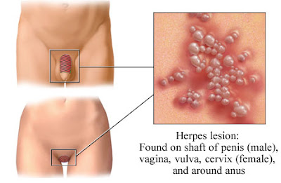 Herpes Genitalis