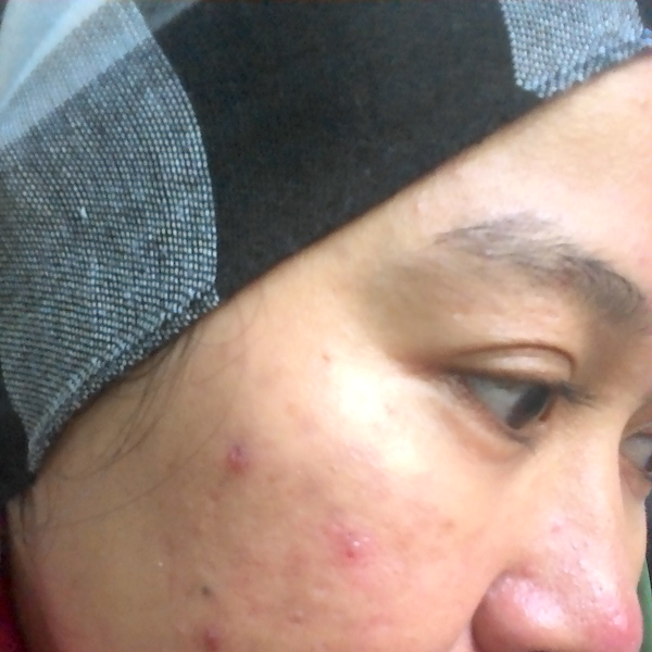 Tiga Minggu Setelah Perawatan Kulit Di  NMW Skin Care 