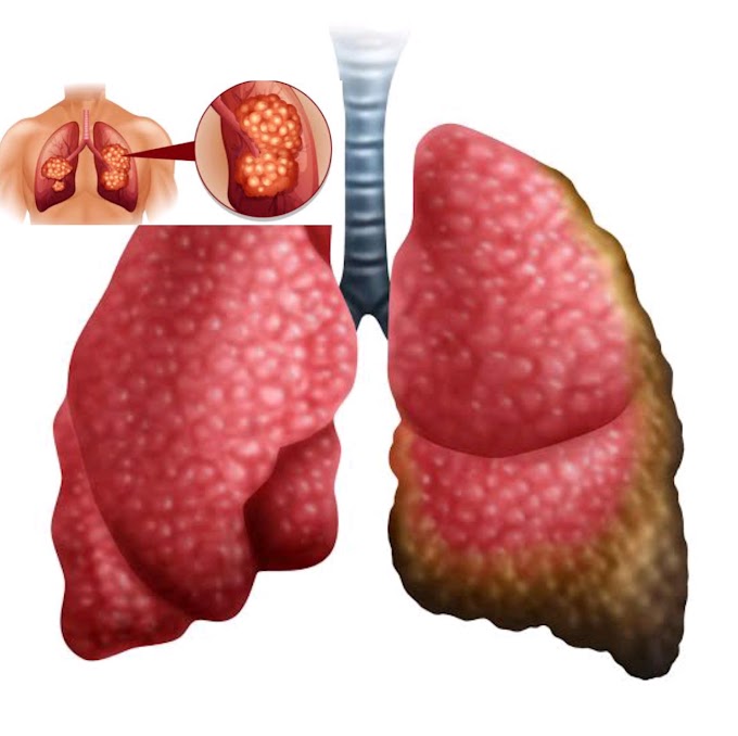  Bronchoscopy & Lung Nodule Biopsy | Fox Chase Cancer Center