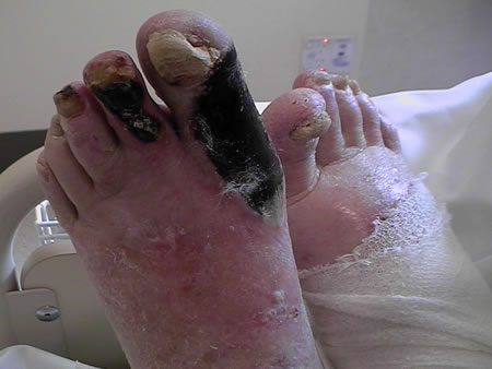 Peripheral Vascular Disease Of The Feet