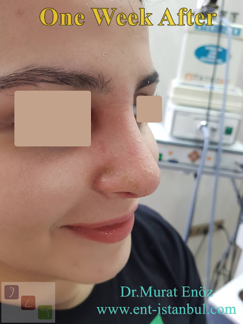 nose aesthetic surgery for female patient, rhinoplasty for women istanbul, nose job in Turkey, one week after rhinoplasty photos