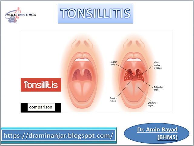 tonsillitis symptoms