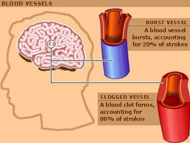 causes stroke symptoms by