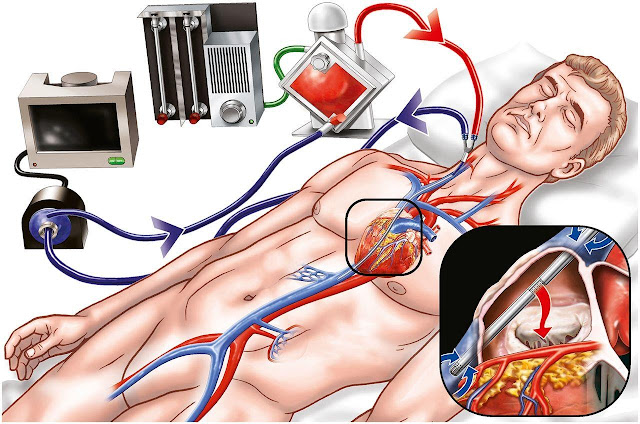 Extracorporeal Membrane Oxygenation System