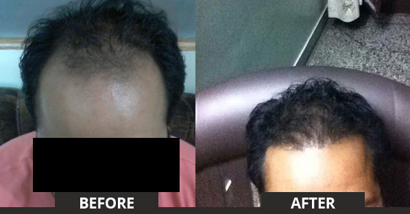 Hair transplant in surat