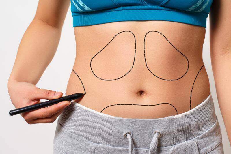 Hút mỡ vùng bụng để giảm cân không cần tập thể dục