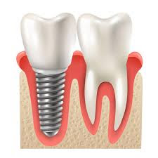 Dental implants in Gurgaon