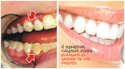  Sarro-dientes