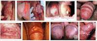 Timbul Rasa Gatal di Penis dan Bernanah Apakah Bahaya?