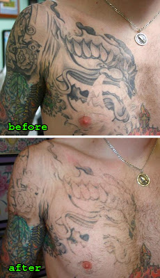 Tattoo Removal Options