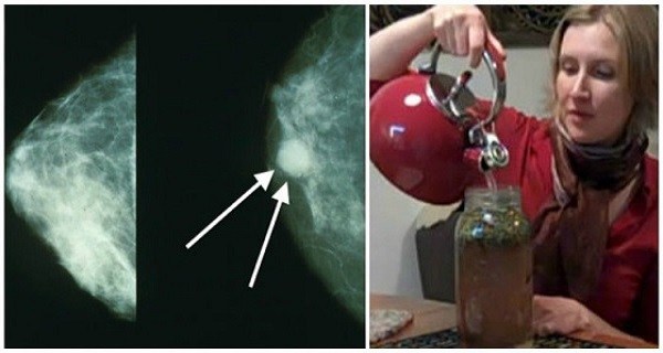 She Cured Her BREAST CANCER with This Tea! She Now Recommends It to Every Woman!