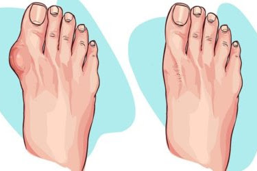 Get Rid of Bunions Naturally With This Simple But Powerful Remedy
