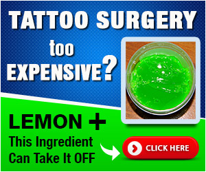 Tattoo Surgery too Expensive ?