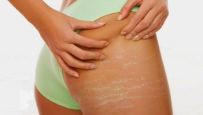 The anti-cellulite properties of the centella asiatica