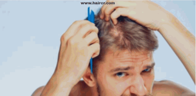 Hair loss problems in men