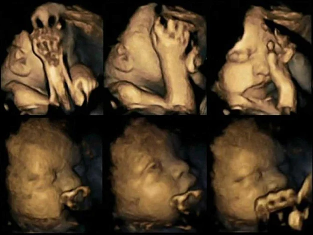 Ultrasounds Of Pregnant 