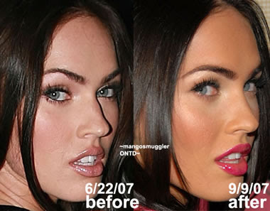 megan fox plastic surgery