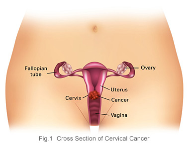 Sekilas Tentang Penyakit Kanker Serviks