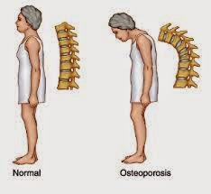 http://herbalnya.blogspot.com/2014/05/obat-herbal-osteoporosis.html