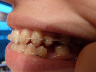 A side on photograph of teeth with ceramic fixed braces at week 10 of treatment