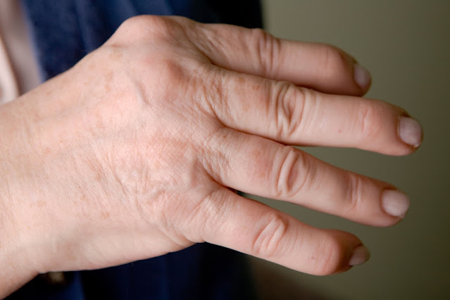 Psoriatic Arthritis