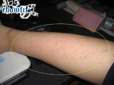 heat rashes on babies. heat rash on abies pictures.