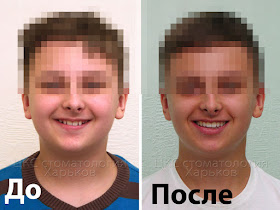 пациент до и после лечения брекетами