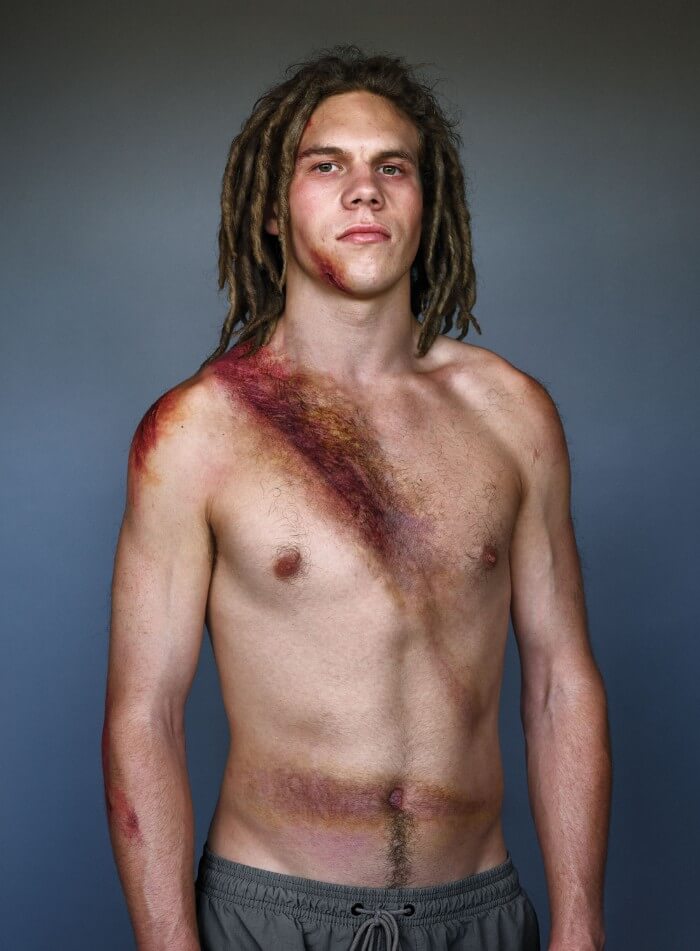 10 Powerful Pictures Of Car Crash Survivors Who Want To Raise Awareness About Seatbelt Safety