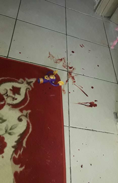 'Kuku dan isi jari anak terpaksa dipotong gara-gara mainan 