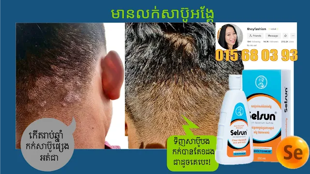 សាប៊ូកក់សក់កម្ចាត់អង្គែ