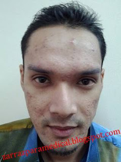 zarraz paramedical, ditinggal kekasih kerana jerawat, cara mengatasi kulit sensitif, produk untuk kulit sensitif, cara merawat kulit sensitif, cara menghilangkan bekas jerawat, ubat kulit sensitif