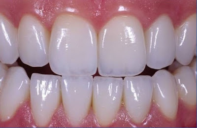 Ưu điểm của phương pháp bọc răng sứ là gì