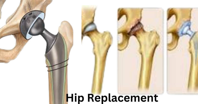 Hip Replacement-Surgery Information