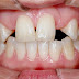 Quy trình bọc răng sứ đạt chuẩn tại nha khoa