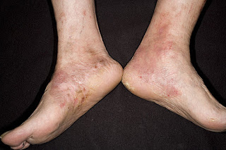 Eczema On Feet